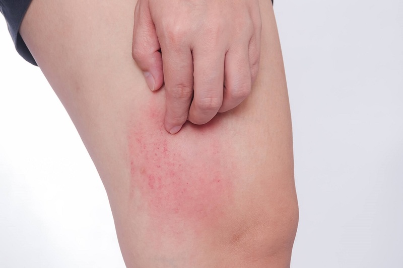 nổi mề đay là gì